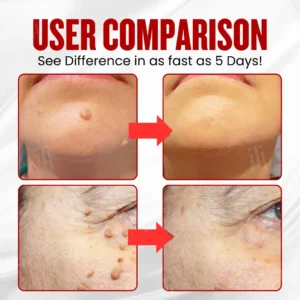 See Results in 3-5 Days with Dobshow® WartAway Pro Patches.