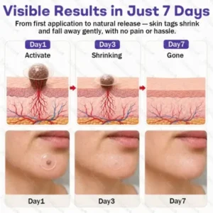 Dobshow® Wart and mole removal microneedle patch