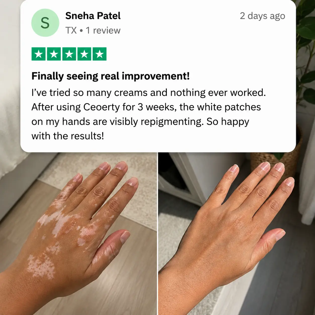 100K+ SOLD 🔥 Dobshow® Herbal Vitiligo Cream