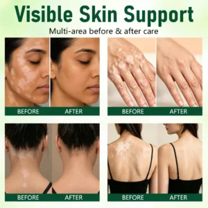 100K+ SOLD 🔥 Dobshow® Herbal Vitiligo Cream
