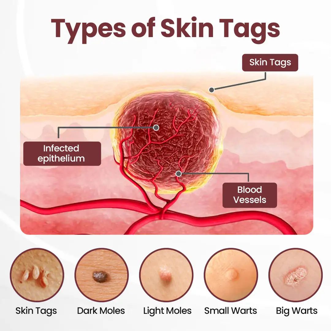 100K+ SOLD 🔥 Dobshow® KeraErase Dual-Action Renewal Cream (New Formula)