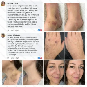 💥300K+ SOLD💕- Dobshow® Bruise Shield & Skin-Strengthening Cream