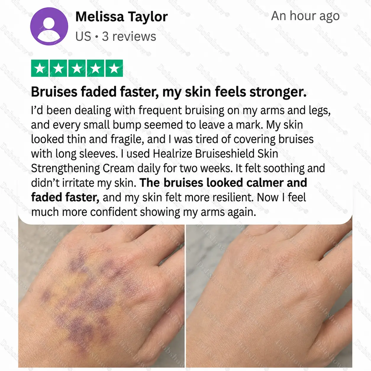💥300K+ SOLD💕- Dobshow® Bruise Shield & Skin-Strengthening Cream