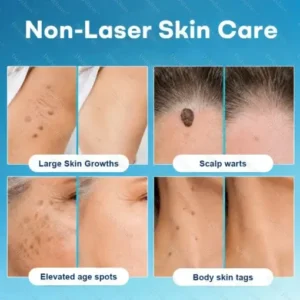 Dobshow® 7-Day Blemish Remover Pain-Free & Scar-Free Advanced Roller Pen for Skin Tags and Spots