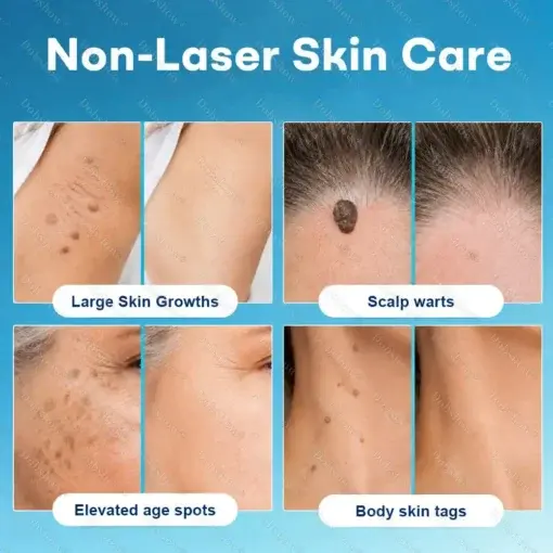 Dobshow® 7-Day Blemish Remover Pain-Free & Scar-Free Advanced Roller Pen for Skin Tags and Spots