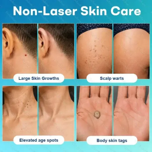Dobshow® 7-Day Blemish Remover Pain-Free & Scar-Free Advanced Roller Pen for Skin Tags and Spots