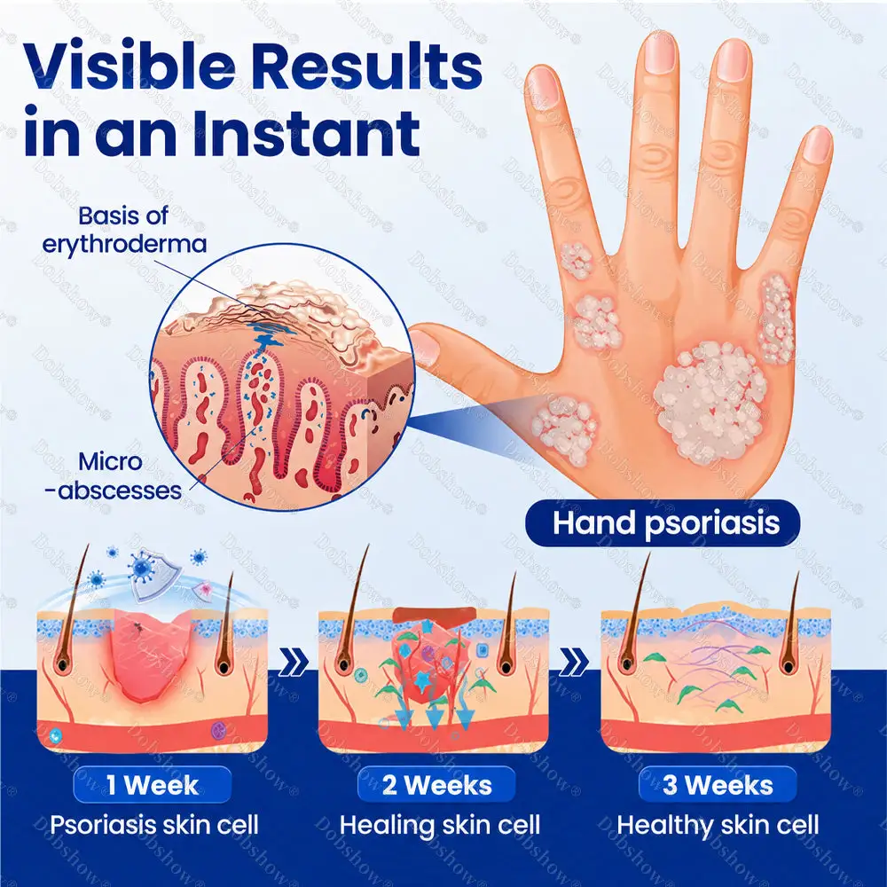 Dobshow® Advanced Psoriasis Relief Spray