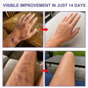 Dobshow® Dark Spot & Bruise Recovery Cream