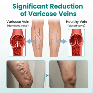 Dobshow® LegRenew Varicose Vein Patch