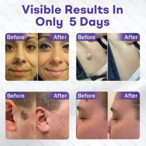 OFFICIAL
BRAND
Dobshow® Wart and mole removal microneedle patch