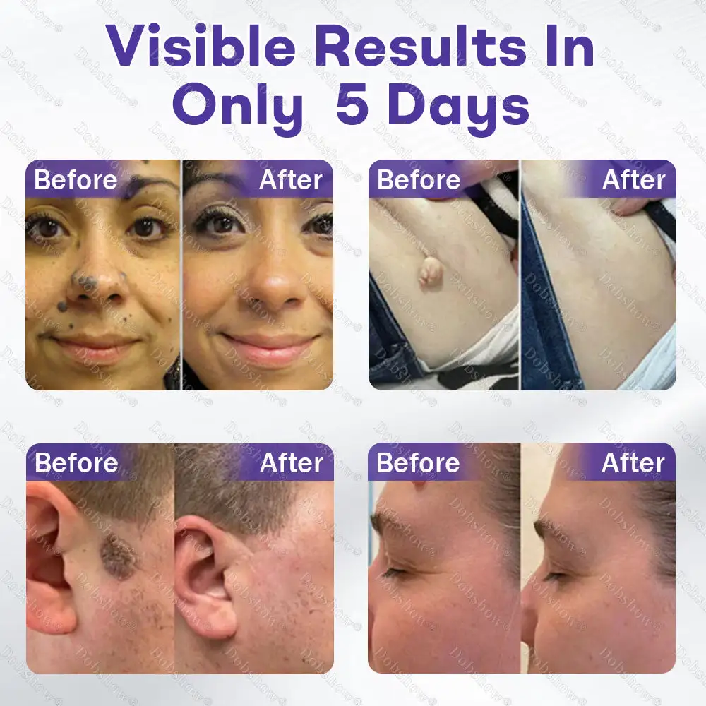 OFFICIAL
BRAND
Dobshow® Wart and mole removal microneedle patch