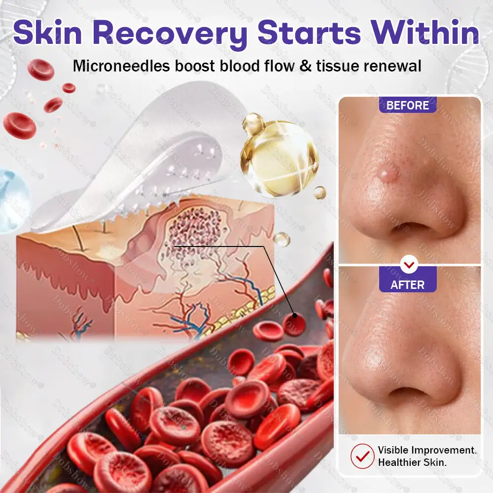OFFICIAL
BRAND
Dobshow® Wart and mole removal microneedle patch