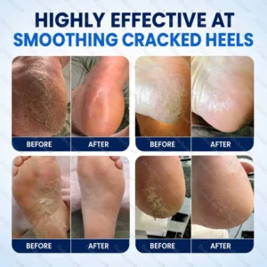 ⭐ Advanced Heel Repair ·Dobshow® 2% Salicylic Acid Callus & Cracked Heel Spray