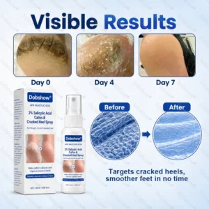 ⭐ Advanced Heel Repair ·Dobshow® 2% Salicylic Acid Callus & Cracked Heel Spray