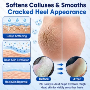 ⭐ Advanced Heel Repair ·Dobshow® 2% Salicylic Acid Callus & Cracked Heel Spray