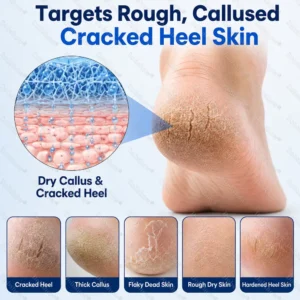 ⭐ Advanced Heel Repair ·Dobshow® 2% Salicylic Acid Callus & Cracked Heel Spray