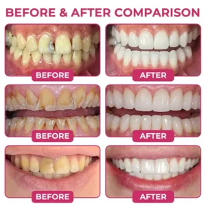 🏆𝐎𝐟𝐟𝐢𝐜𝐢𝐚𝐥 𝐔𝐒 𝐒𝐭𝐨𝐫𝐞🎉Over 100K+ Sold🔥Dobshow® 🦷 DenPerm Advanced Enamel Repair Biomimetic Protein Gel