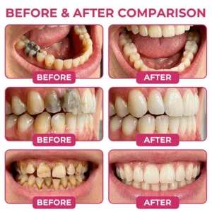 Dobshow® 🦷 DenPerm Cavity-Repair Advanced Enamel Filling Gel