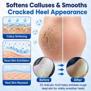 Dobshow® Medical-Grade 2% Salicylic Acid Callus & Cracked Heel Repair Spray