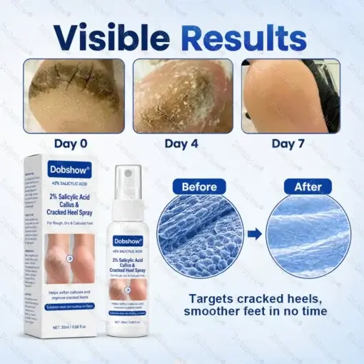 Dobshow® Medical-Grade 2% Salicylic Acid Callus & Cracked Heel Repair Spray